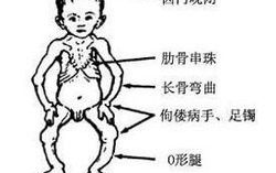 佝偻病的早期症状,关注儿童健康的关键信号